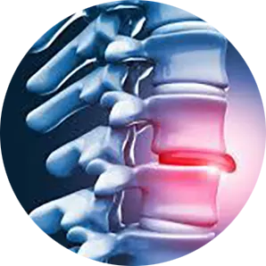 Disc Injury Treatment Near Me in Little Falls, NJ. Chiropractor For Disc Injury Pain Relief.